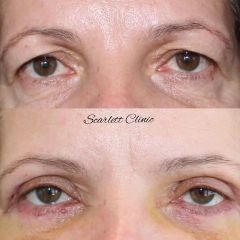 Operácia očných viečok (Blepharoplastika)