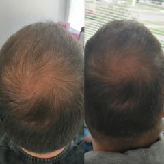 Dracula terapia pre rast vlasov