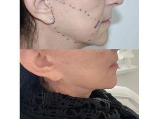 Facelift - Lifestyle lift