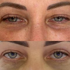 Blefaroplastika - Scarlett Clinic