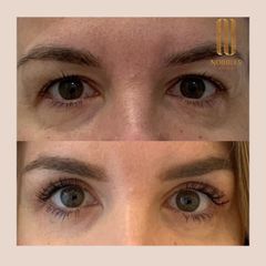 Blefaroplastika - MUDr. Barbora Brezová PhD.
