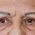 Blepharoplastika, MUDr. Bumbera, Euroclinic, Trnava, úžasný výsledok, som nadšená