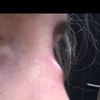 po rhinoplastike meniaci sa gulaty hrbol 5-ty rok